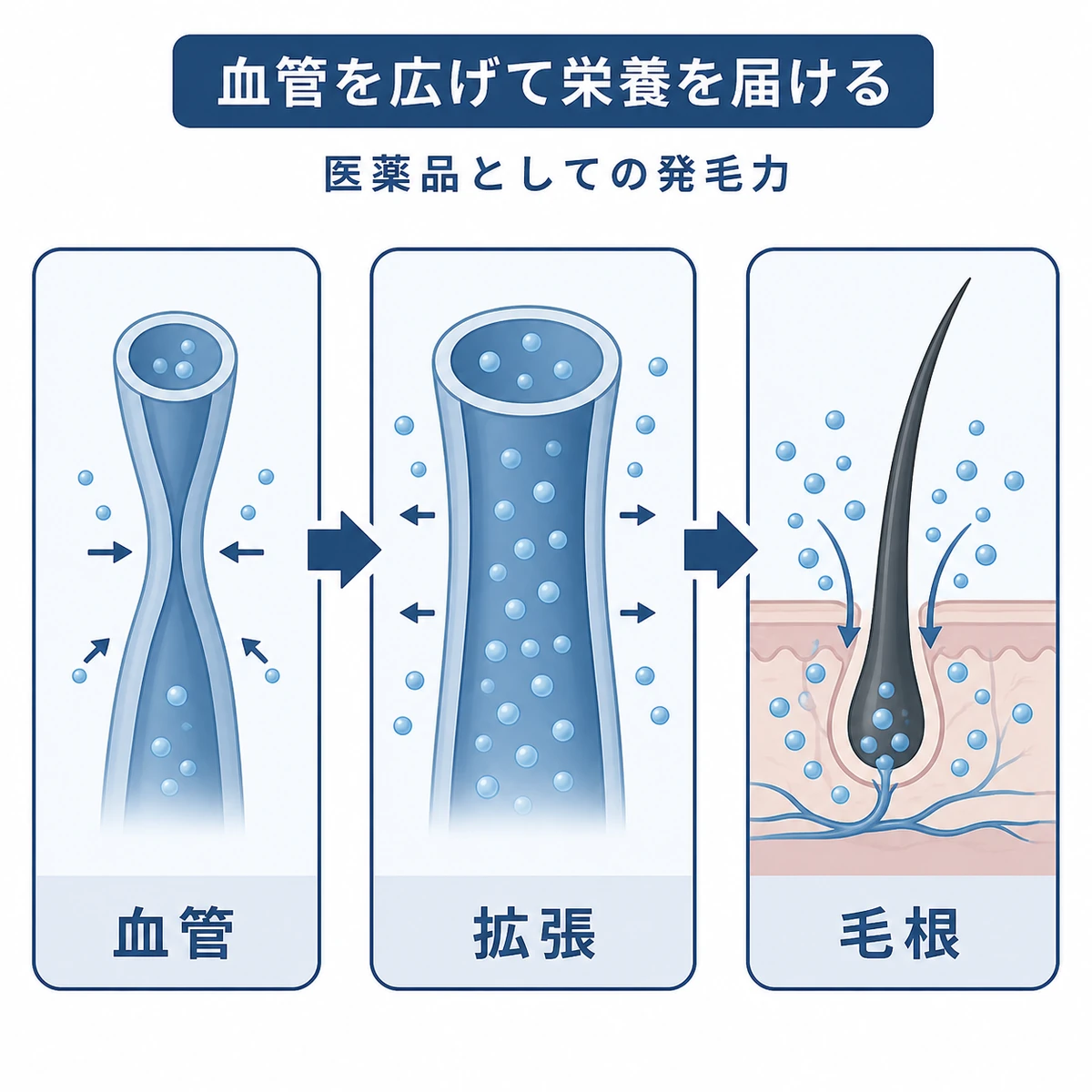 縮んだ血管が拡張して毛根へ栄養が届くまでの流れを表したミノキシジルの医療イラスト