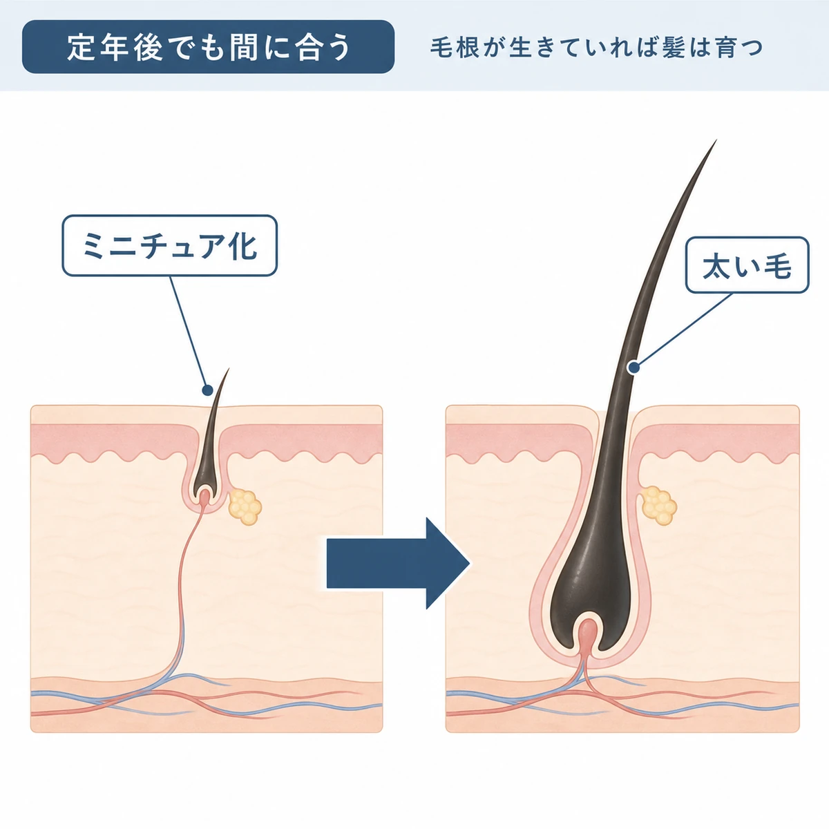 細くなった毛包が治療で再び太い毛を育てる変化を左右で比べた医療イラスト