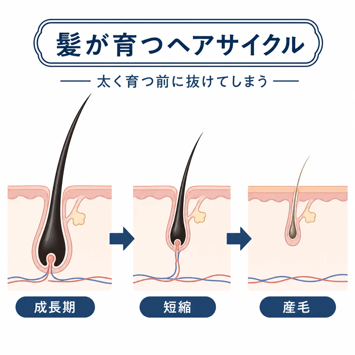 AGAでヘアサイクルの成長期が短くなり髪が細くなっていく流れを示した医療イラスト