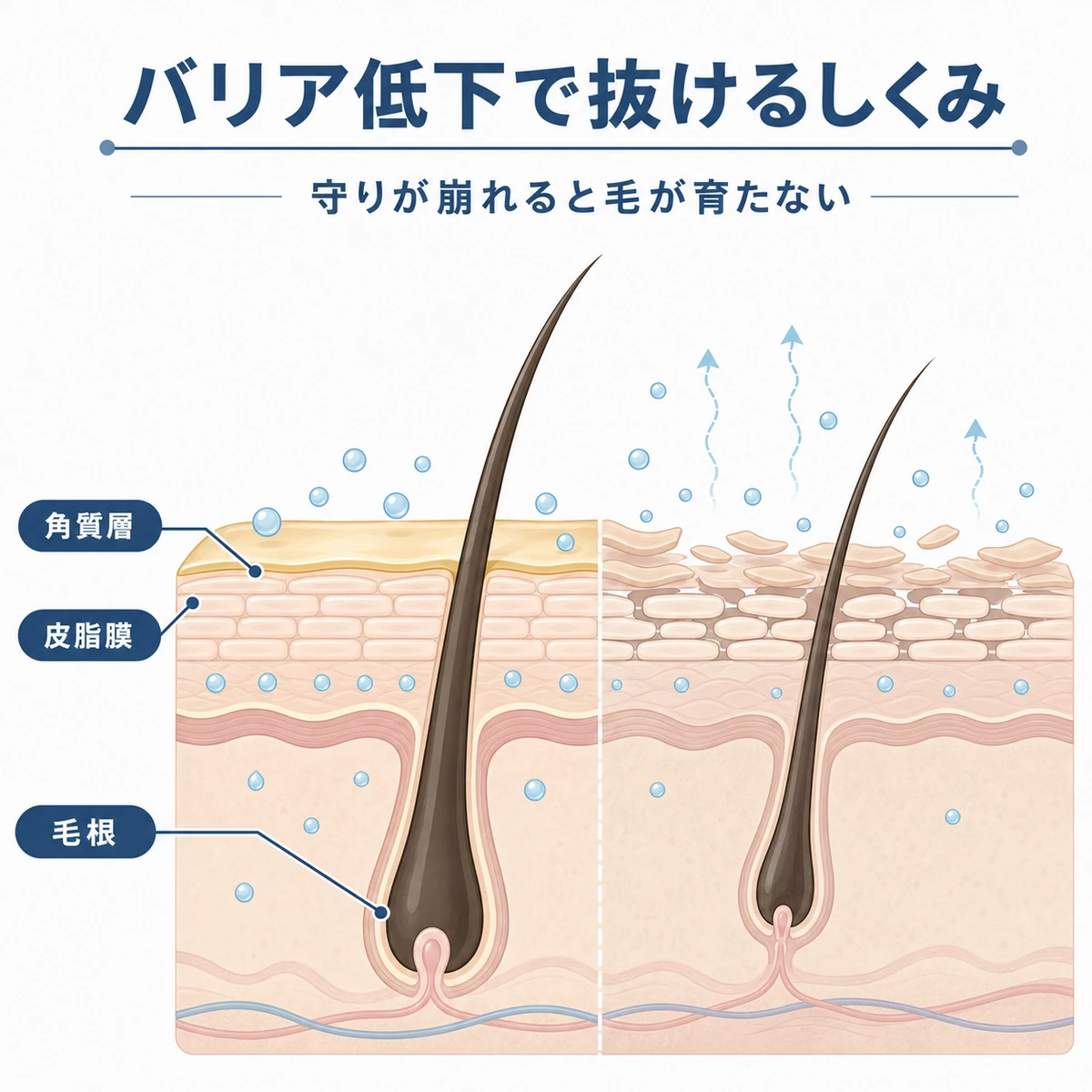 頭皮のバリア機能が低下して毛根が弱り抜け毛につながる仕組みを表した断面イラスト