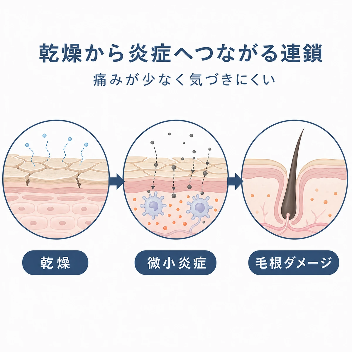 乾燥から微小炎症を経て毛根がダメージを受ける因果の流れを示した医療イラスト