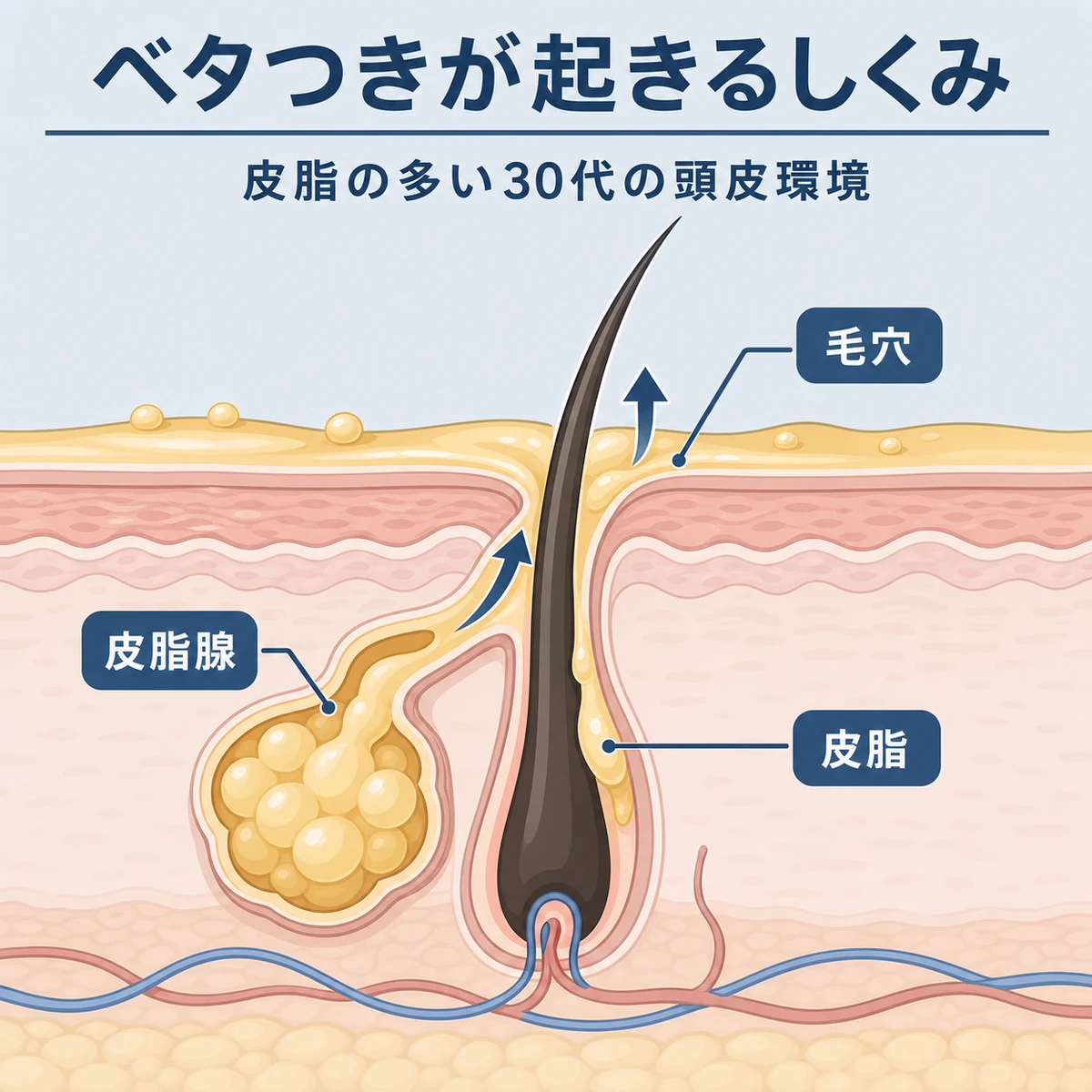 30代男性の頭皮断面と皮脂腺から皮脂がにじむしくみを表した医療イラスト