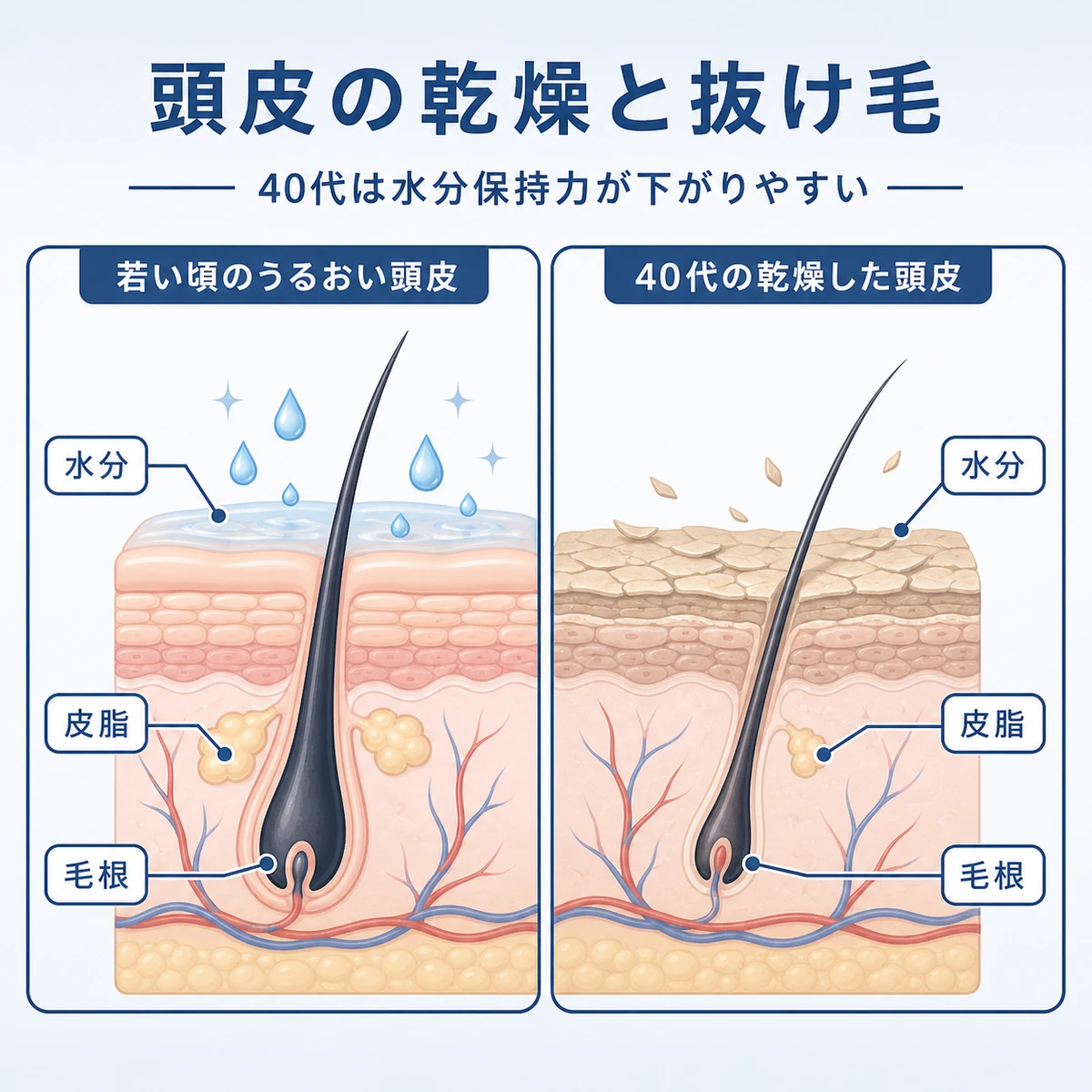 20代と40代で頭皮の水分量がどう違うかを比べた断面図の医療イラスト