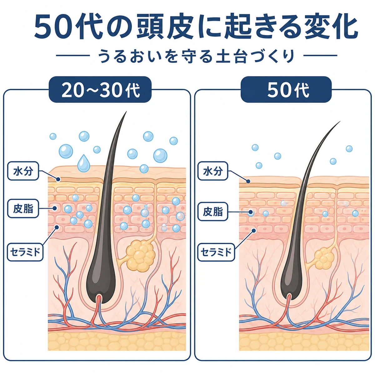 20〜30代と50代の頭皮の断面を並べて水分と皮脂の減少を表した医療イラスト