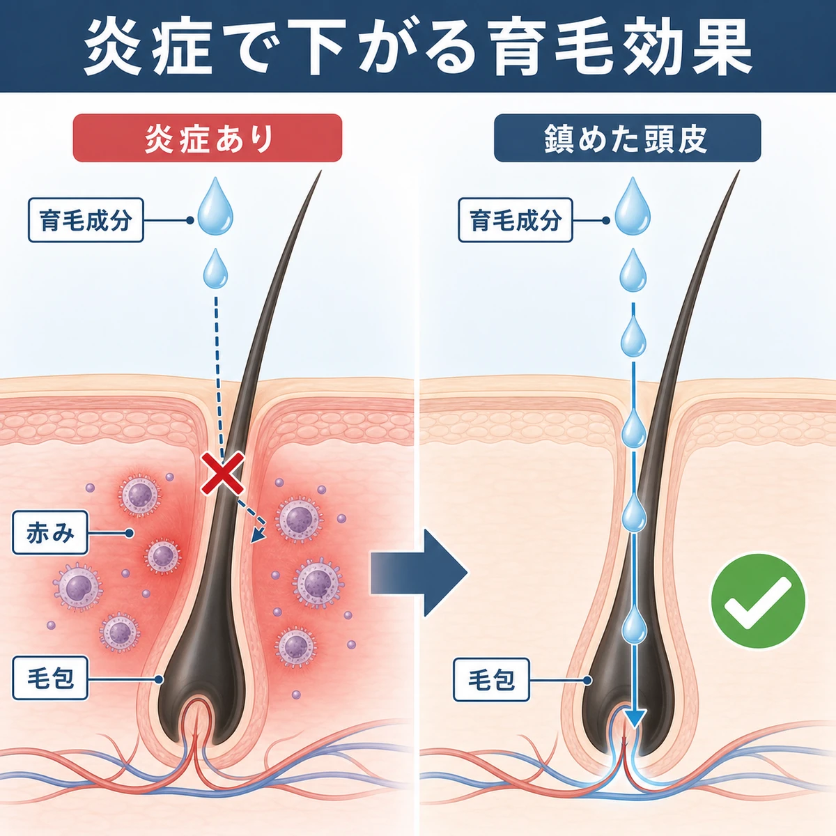 炎症のある頭皮では育毛成分が毛根に届きにくく、鎮静後は浸透しやすくなる違いを表した断面図の医療イラスト