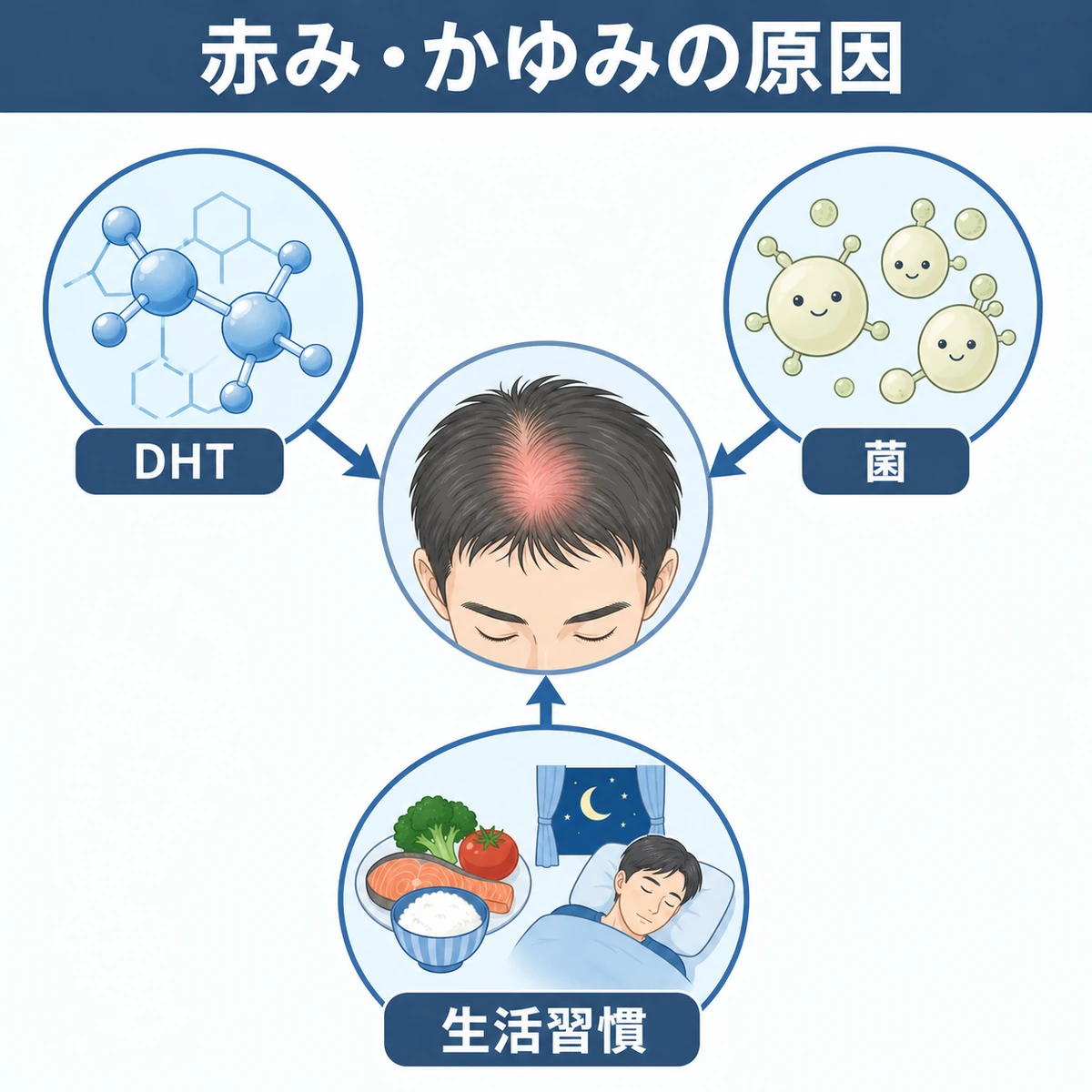 DHTやマラセチア菌、生活習慣など複数の原因が頭皮の赤みとかゆみに関わる関係を表した医療イラスト