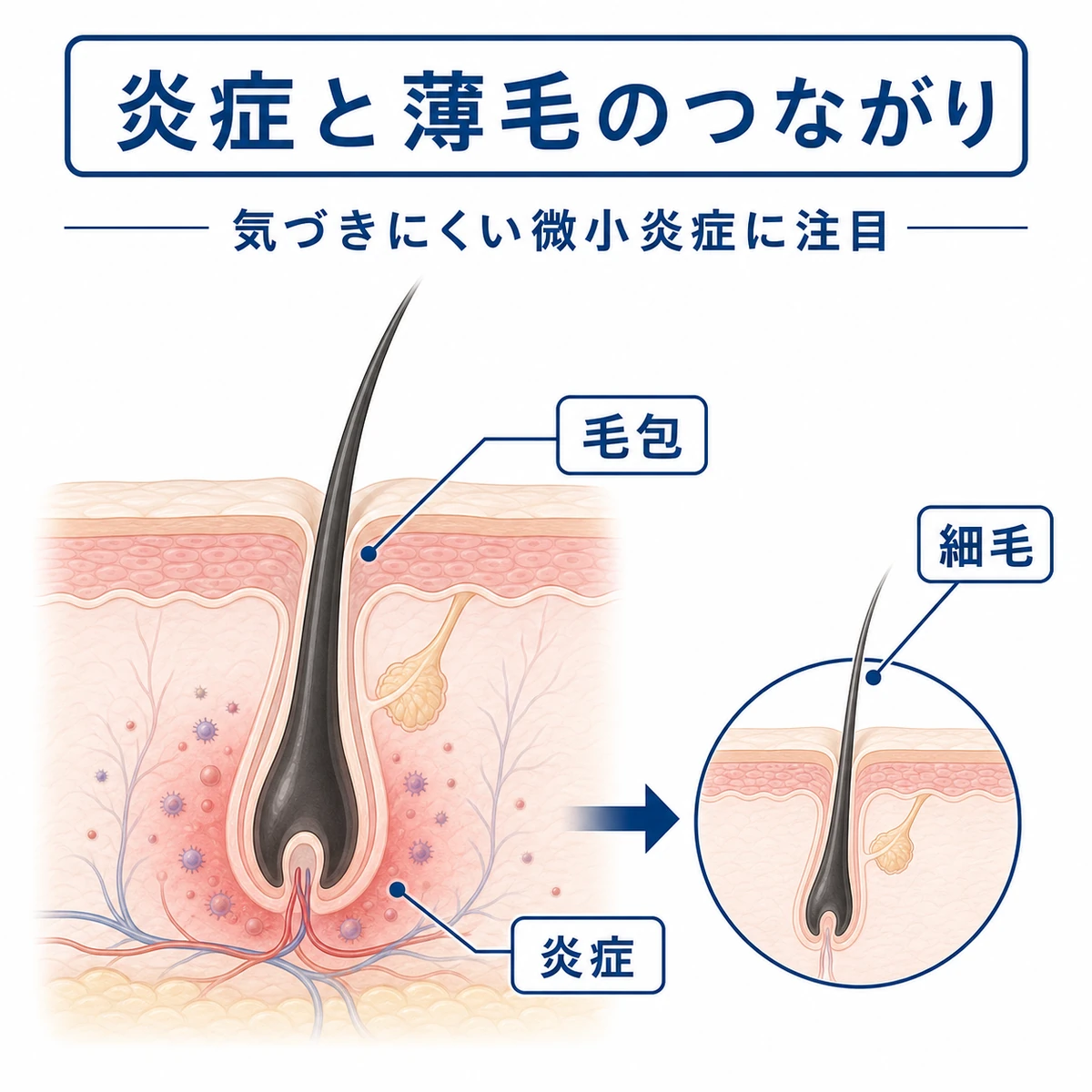 頭皮の炎症が毛根に及び髪が細くなる関係を表した医療イラスト