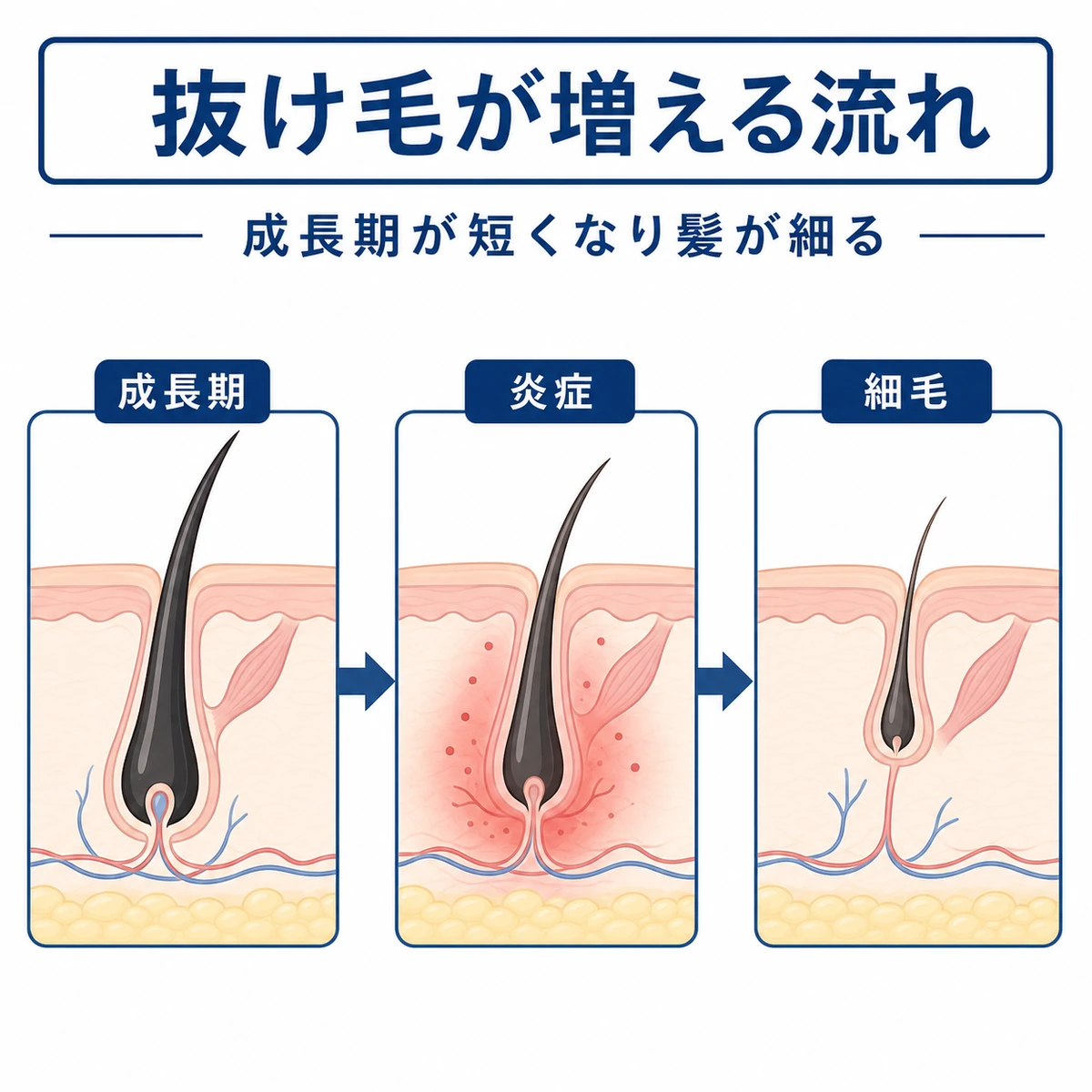 炎症でヘアサイクルが乱れ髪が細く抜けていく流れを表した医療イラスト