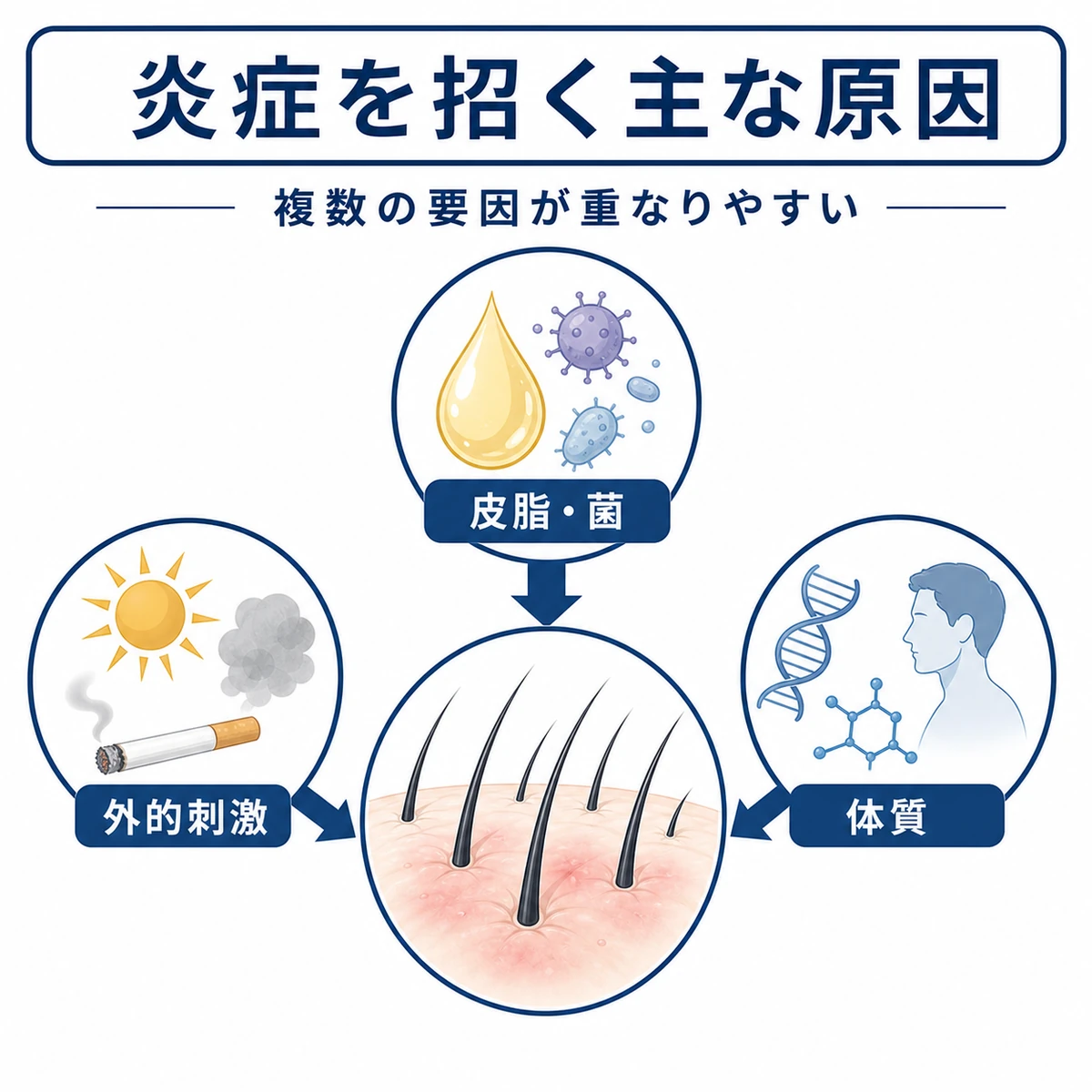 皮脂や外的刺激や体質など頭皮の炎症を招く原因の分類を表した医療イラスト