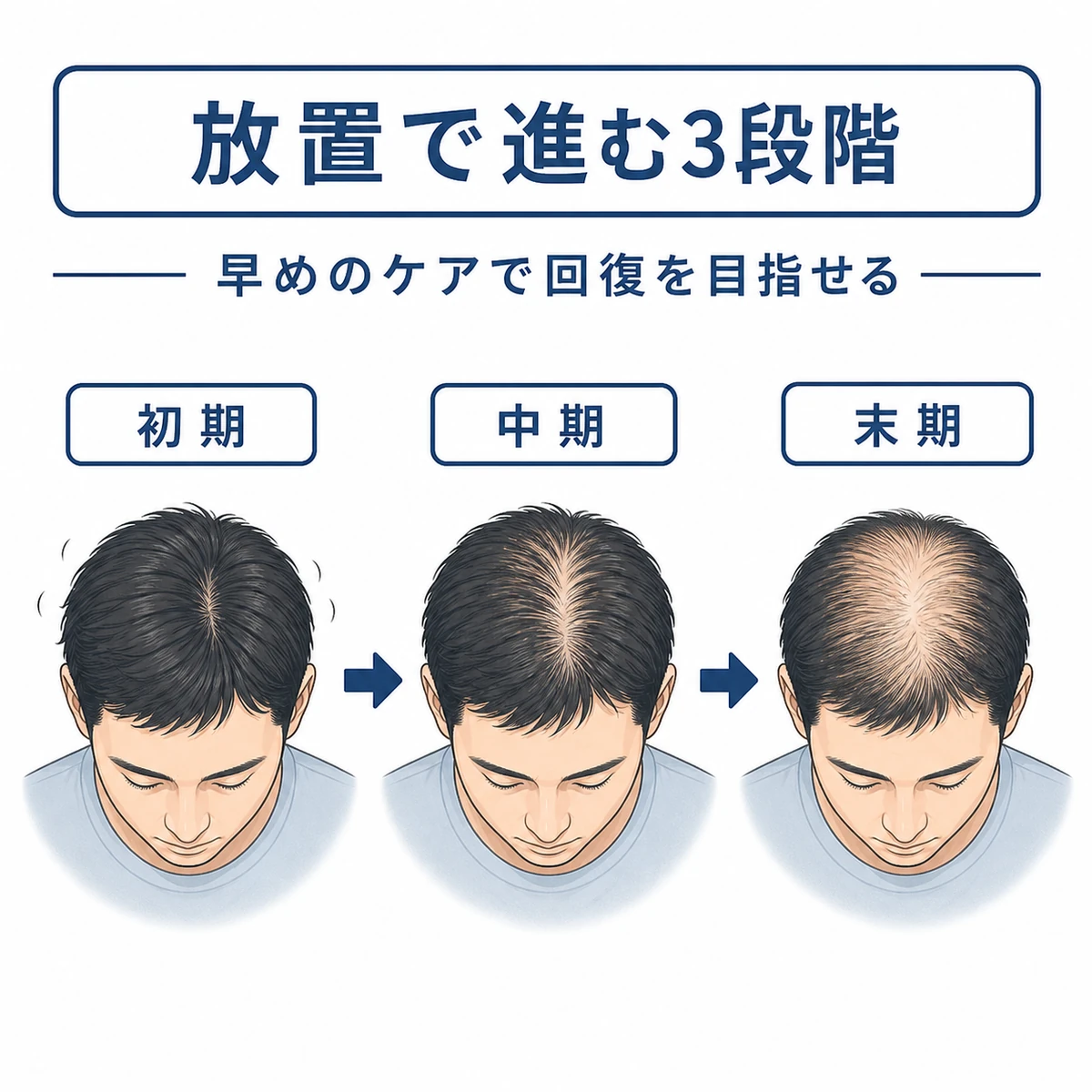 頭皮の炎症を放置した際に薄毛が進む3段階の流れを表した医療イラスト