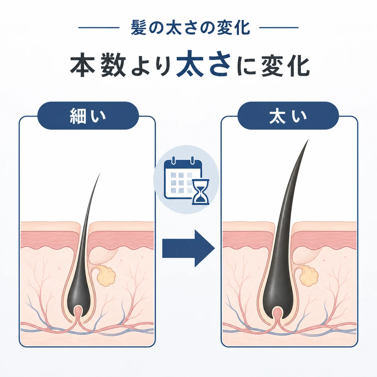 頭皮マッサージ継続前後で毛髪が太くなる変化を対比した医療イラスト