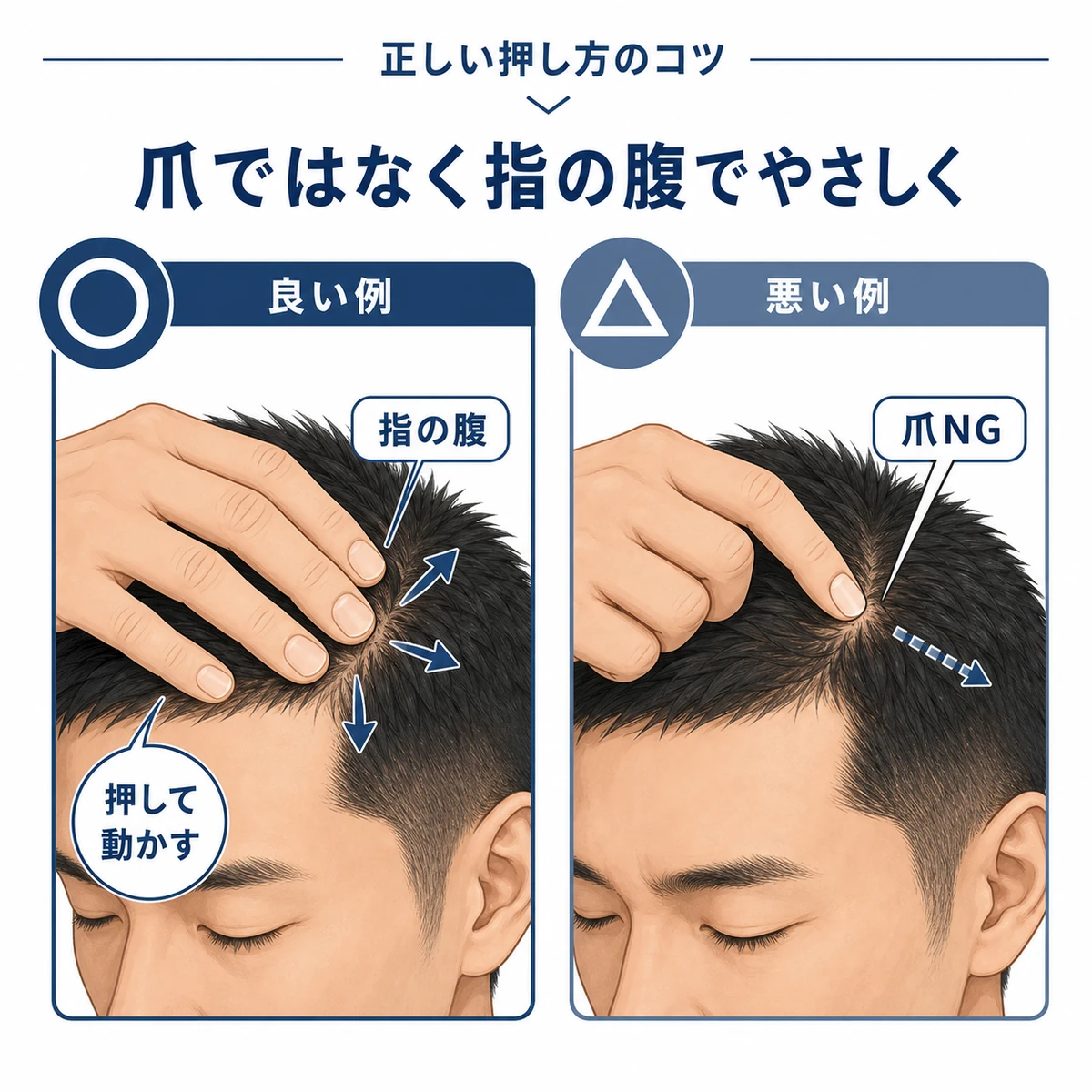 指の腹で頭皮を動かす正しいマッサージと爪を立てる誤った例を対比した医療イラスト