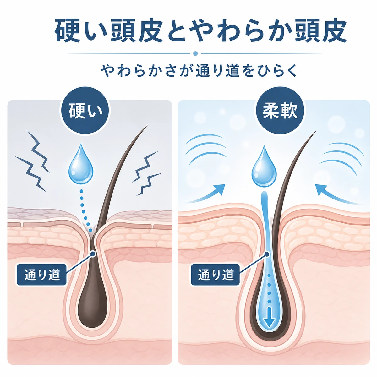 硬い頭皮と柔らかい頭皮で毛穴の通り道が変わる様子を左右で比べた医療イラスト