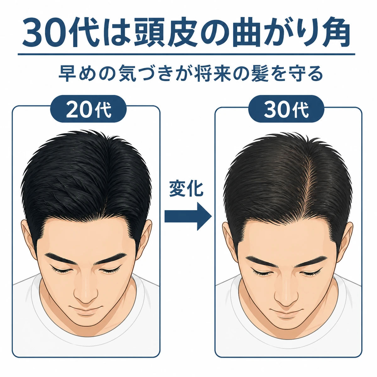 20代と30代で変わる男性の頭皮環境の違いを見比べた医療イラスト