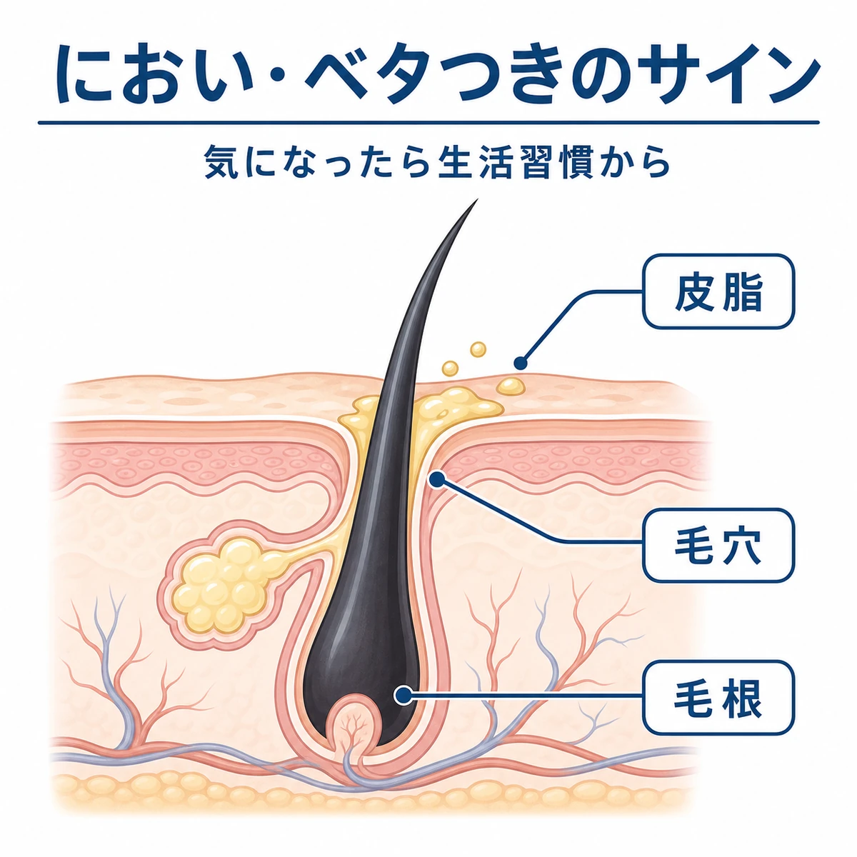 毛穴に皮脂がたまる頭皮の断面を表した医療イラスト