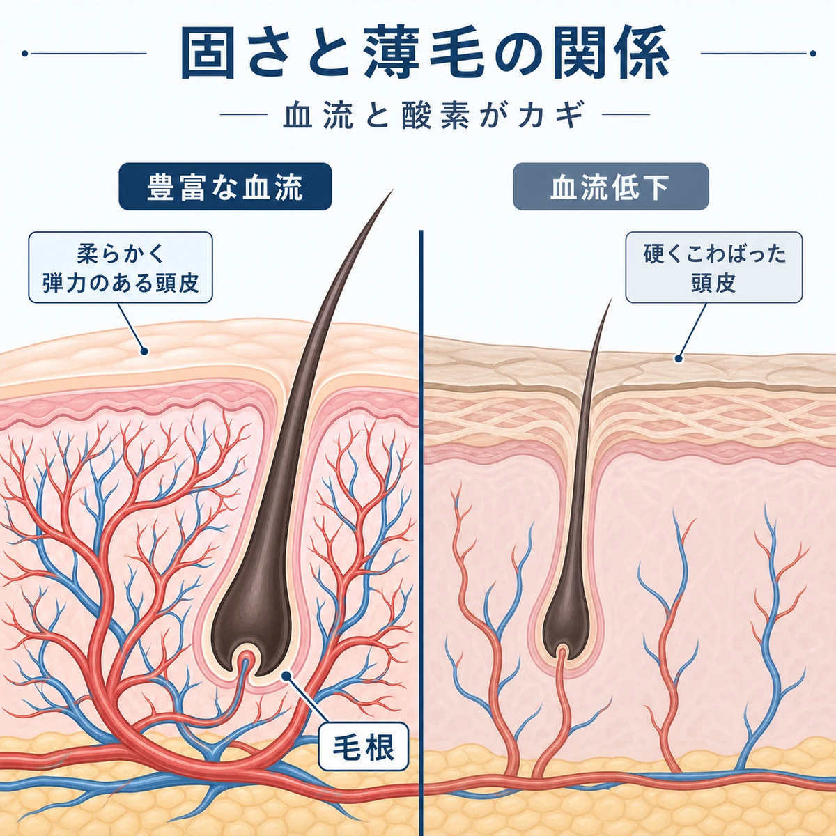 頭皮の断面で血流の多い状態と少ない状態を比べた医療イラスト