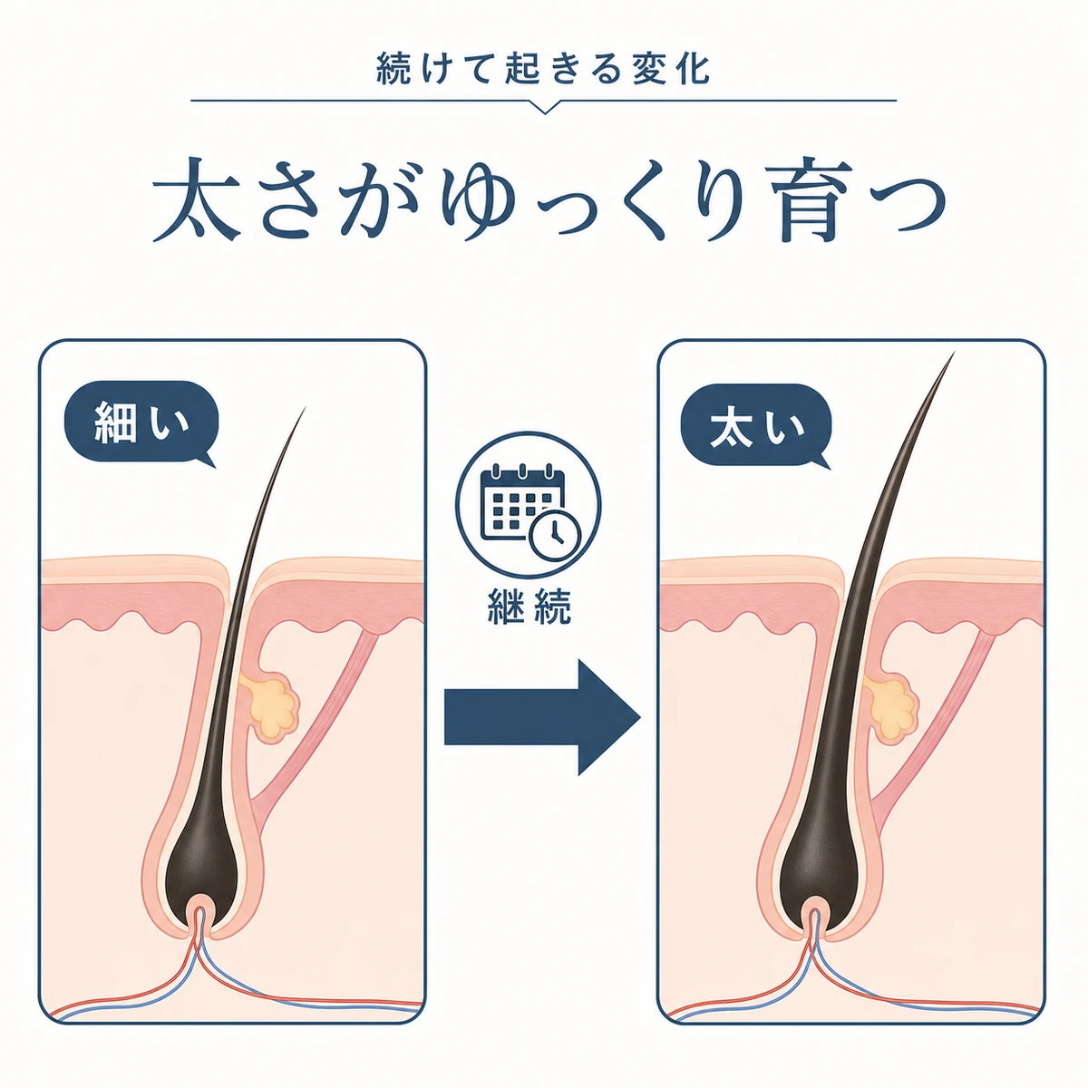 頭皮マッサージの継続で毛が細い状態から太い状態へ育つ変化を比べた医療イラスト