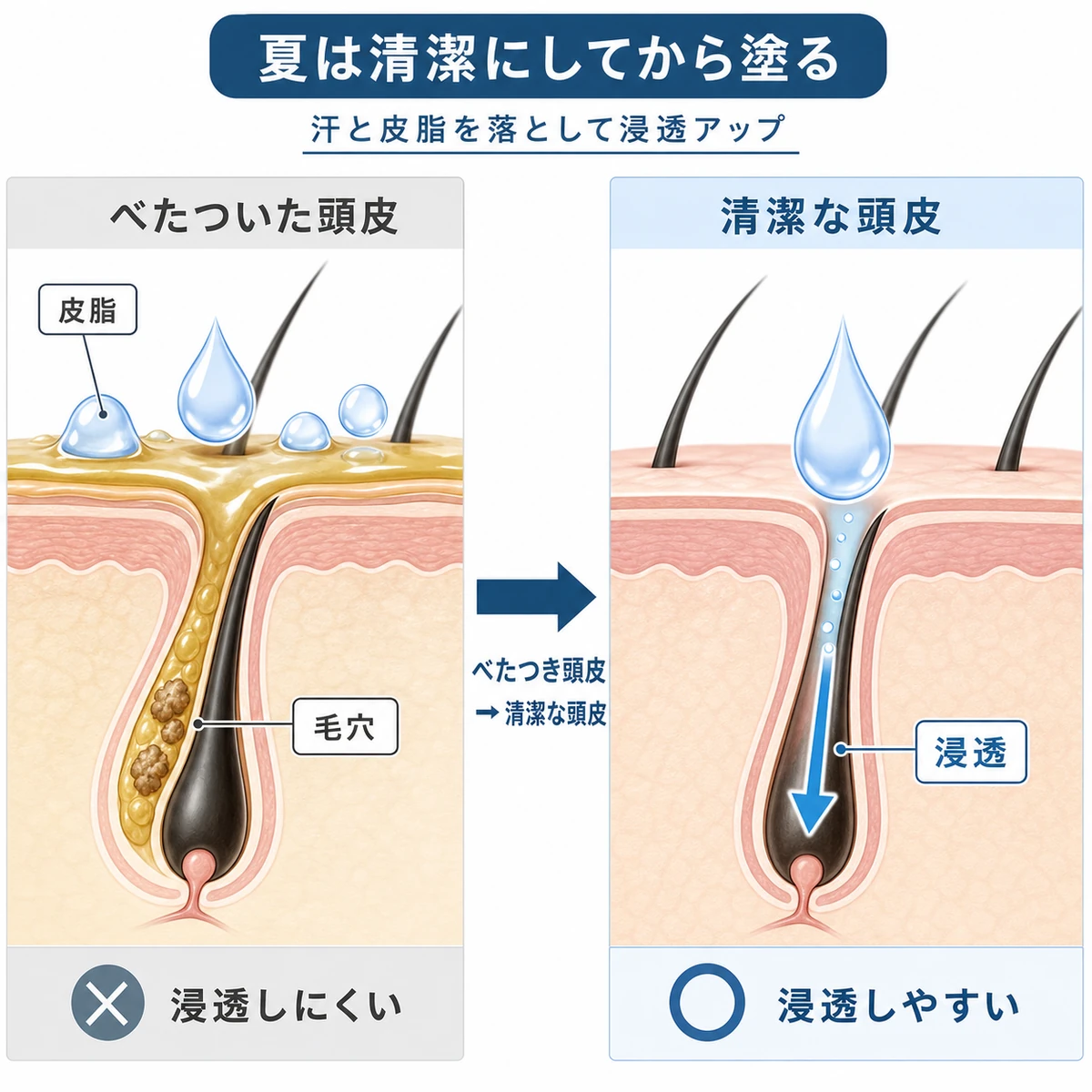 べたついた頭皮を洗って清潔にすると育毛剤が毛穴へ浸透しやすくなる違いを表した医療イラスト