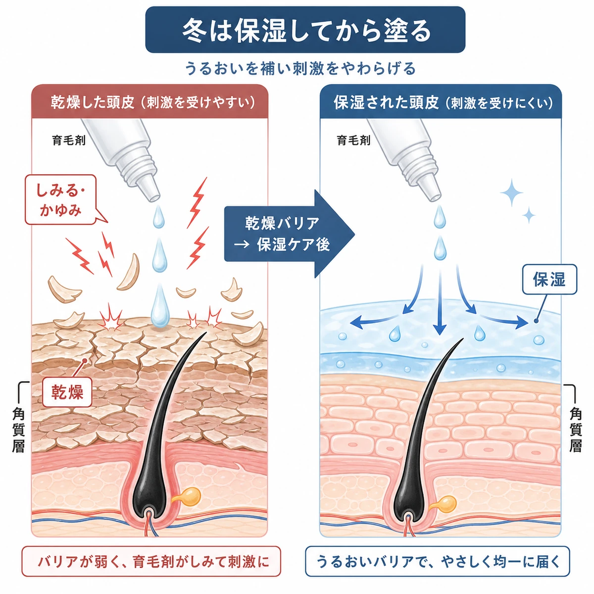 乾燥した頭皮を保湿してから育毛剤を使うと刺激が和らぐ違いを表した医療イラスト