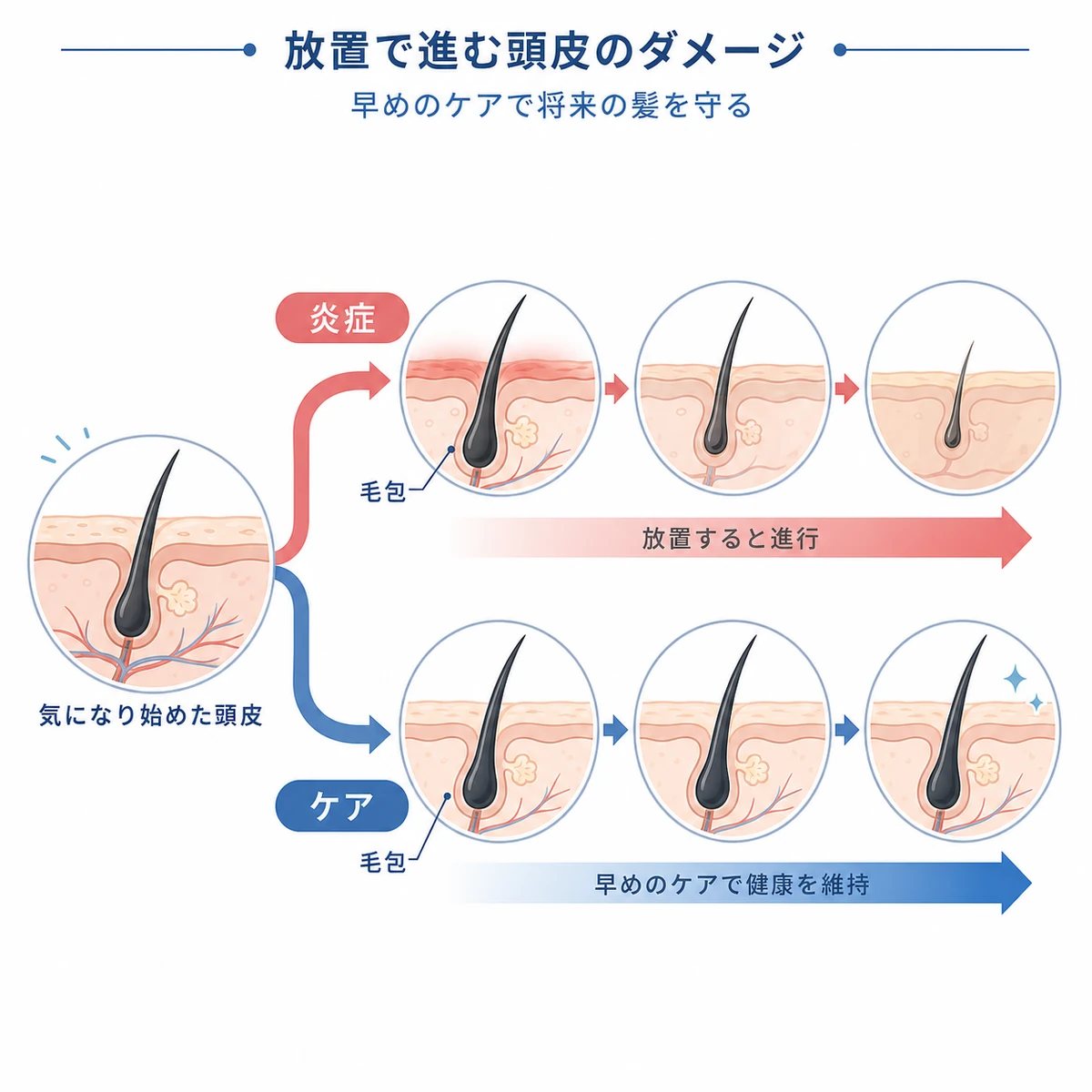 頭皮荒れを放置した場合と早めにケアした場合の毛包の変化を分岐で対比した医療イラスト