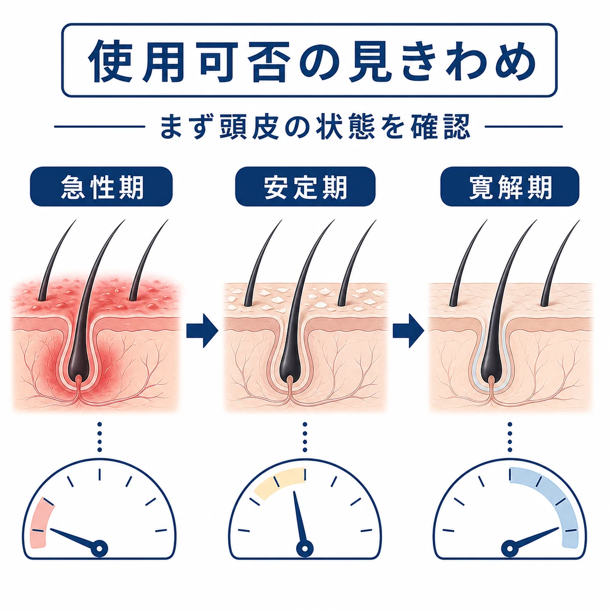 頭皮の炎症段階ごとに育毛剤を使えるかを穏やかに表した医療イラスト