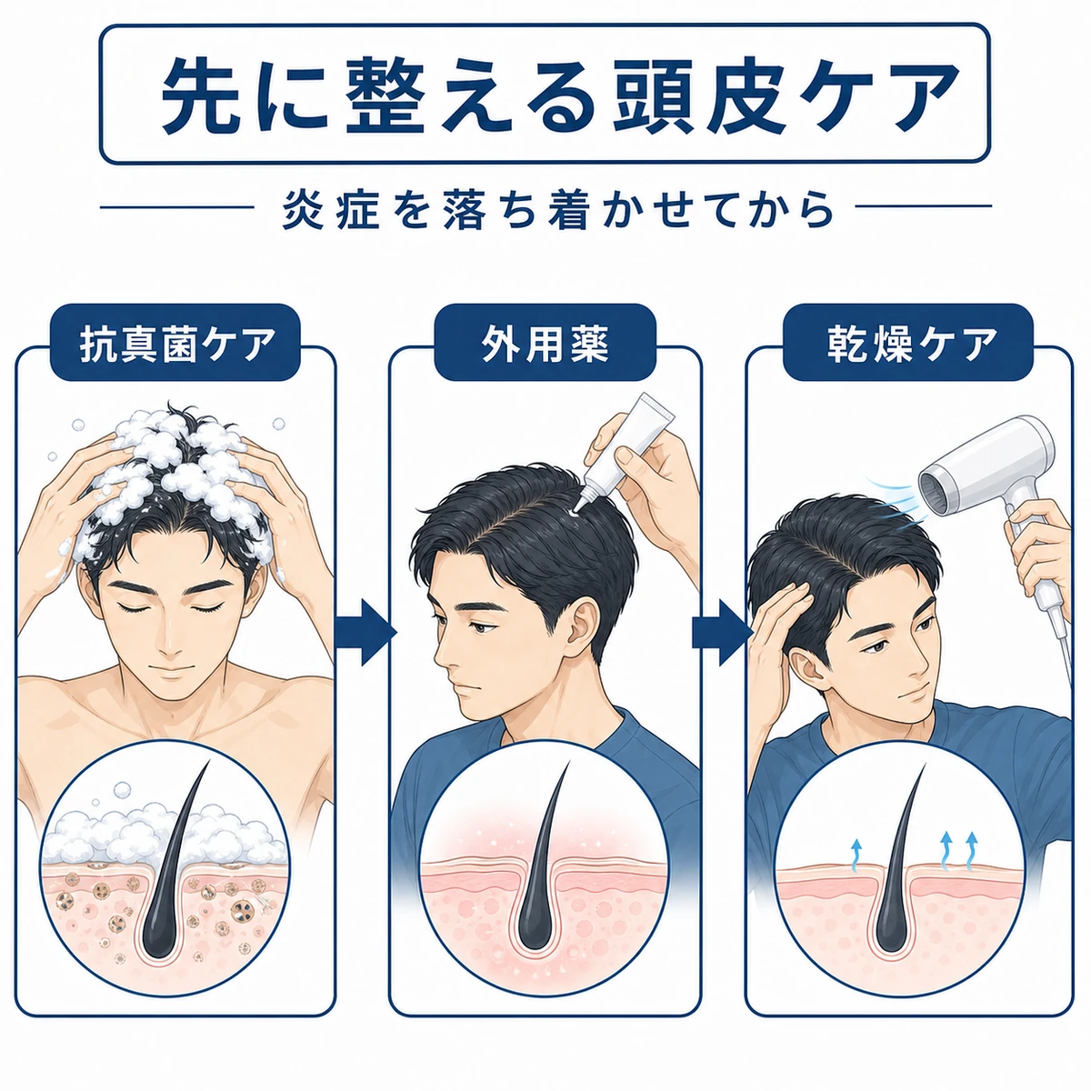 育毛剤の前に行う頭皮ケアの手順を段階的に表した医療イラスト