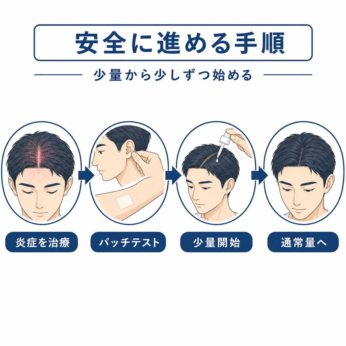 脂漏性皮膚炎の頭皮に育毛剤を段階的に導入する手順を表した医療イラスト