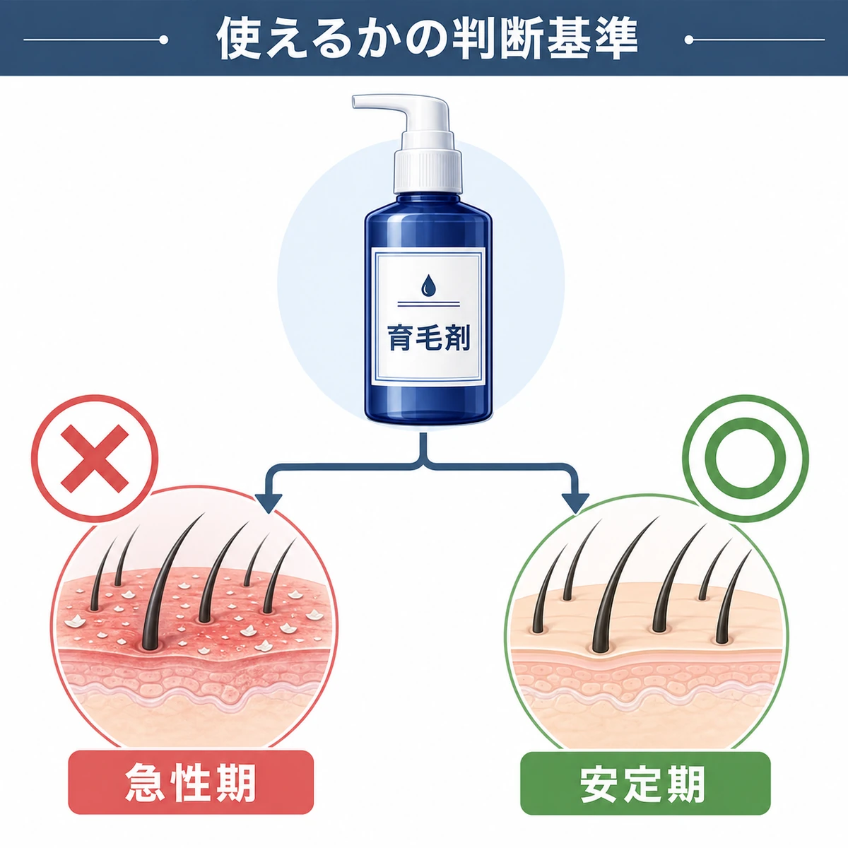 育毛剤を使えるかどうかを頭皮の状態で判断する分岐図を示した医療イラスト