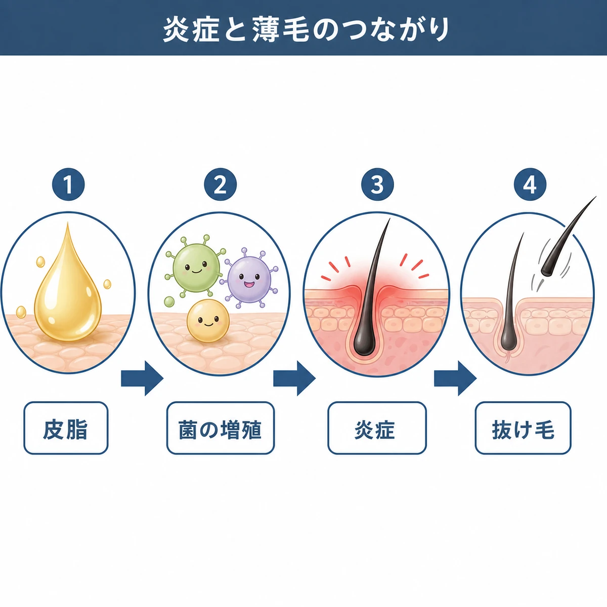 皮脂から菌の増殖と炎症を経て抜け毛につながる流れを表した医療イラスト