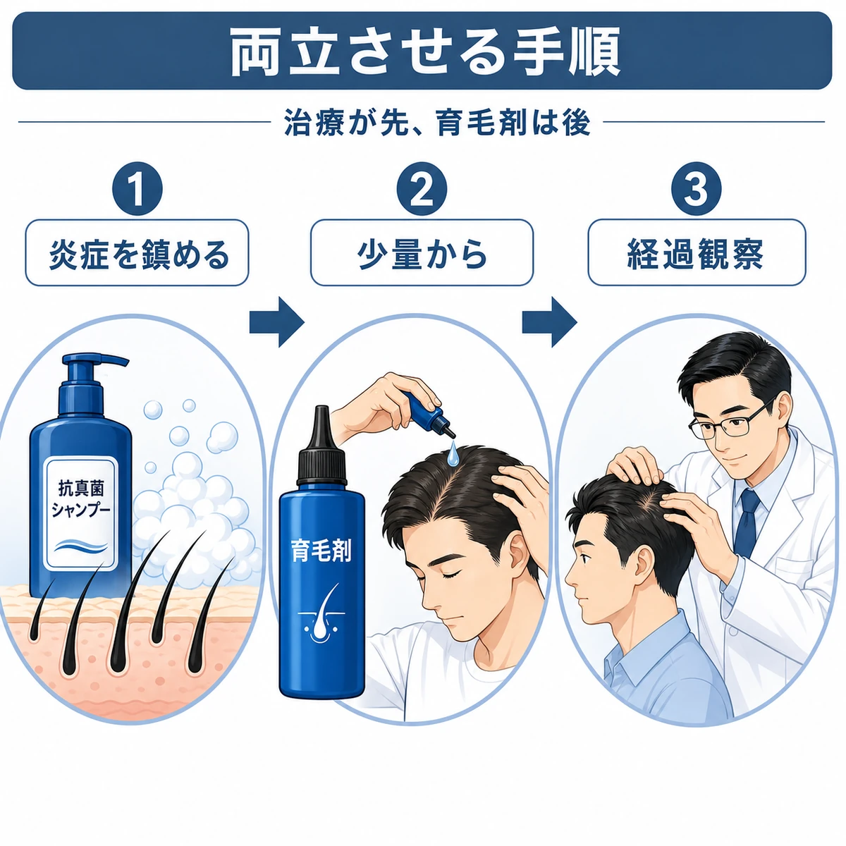 抗真菌治療から育毛剤導入と経過観察へ進む手順を段階で表した医療イラスト