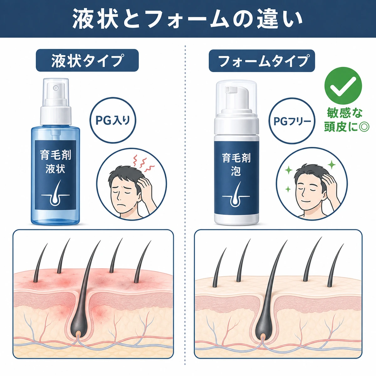 液状タイプとフォームタイプの育毛剤を左右で比べた医療イラスト