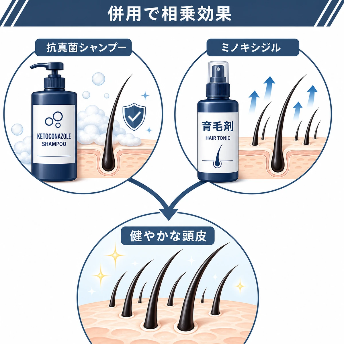 抗真菌シャンプーと育毛剤の併用で頭皮と発毛を同時にケアする相乗効果を表した医療イラスト