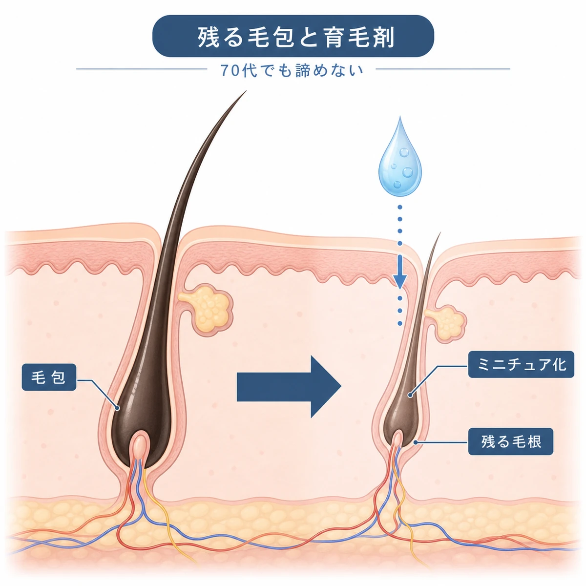 太い毛包が加齢で細くミニチュア化しても毛根が残れば育毛剤が働くしくみを表した医療イラスト