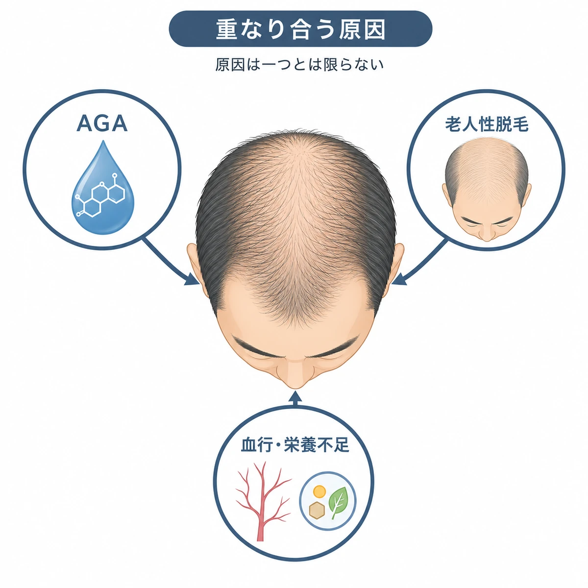 AGAと老人性脱毛症と血行栄養不足が重なって70代の薄毛を招く関係を表した医療イラスト