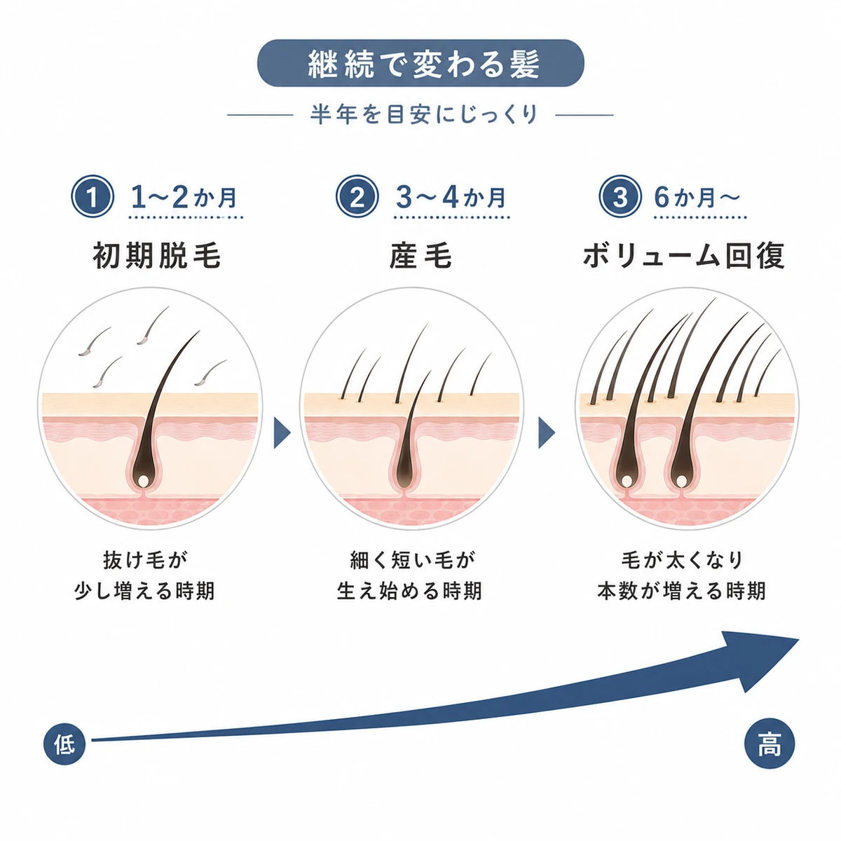 育毛剤を4から6か月続けるほど初期脱毛から産毛そしてボリューム回復へ進む変化を表した医療イラスト