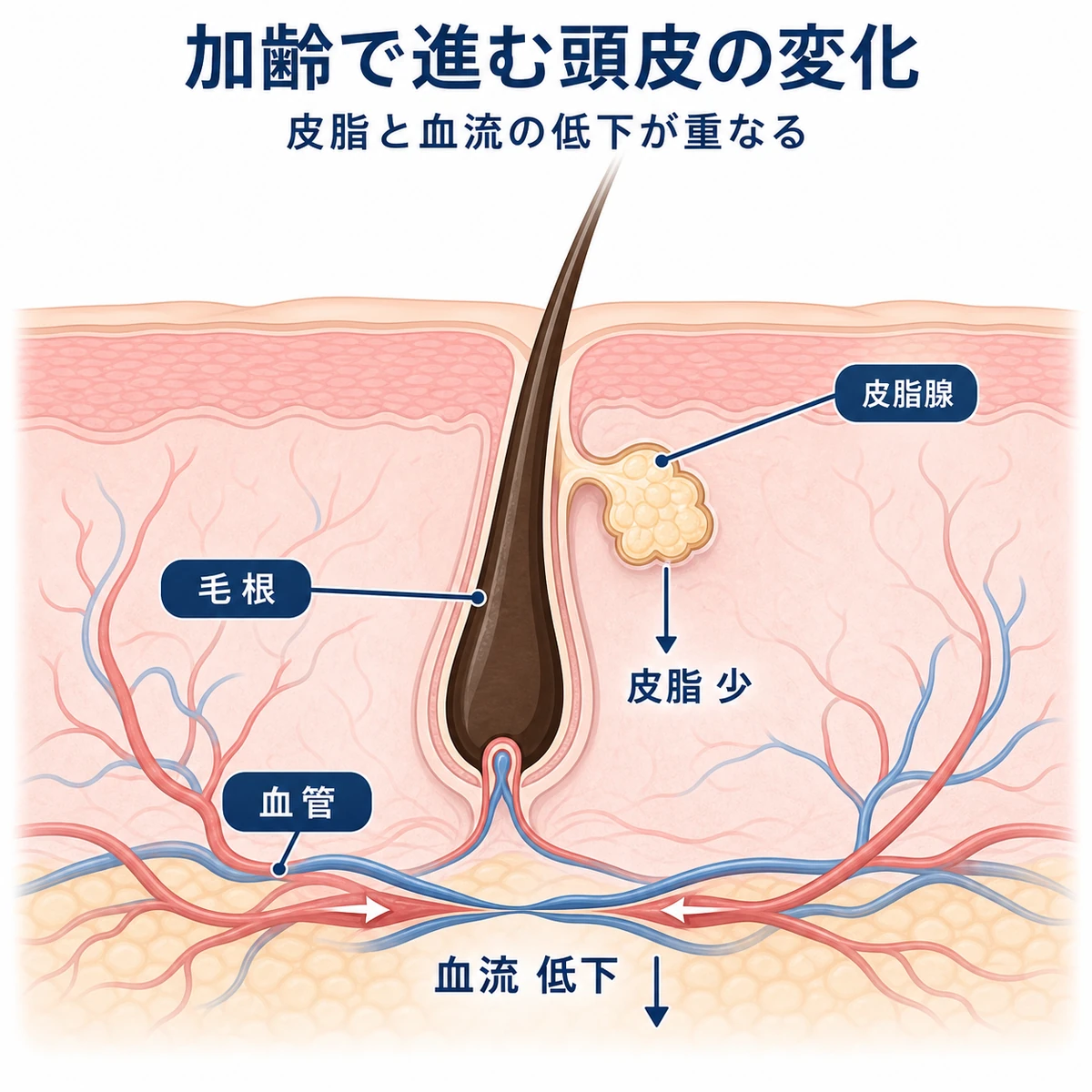 加齢により皮脂と血流が低下していく頭皮の断面を表した医療イラスト