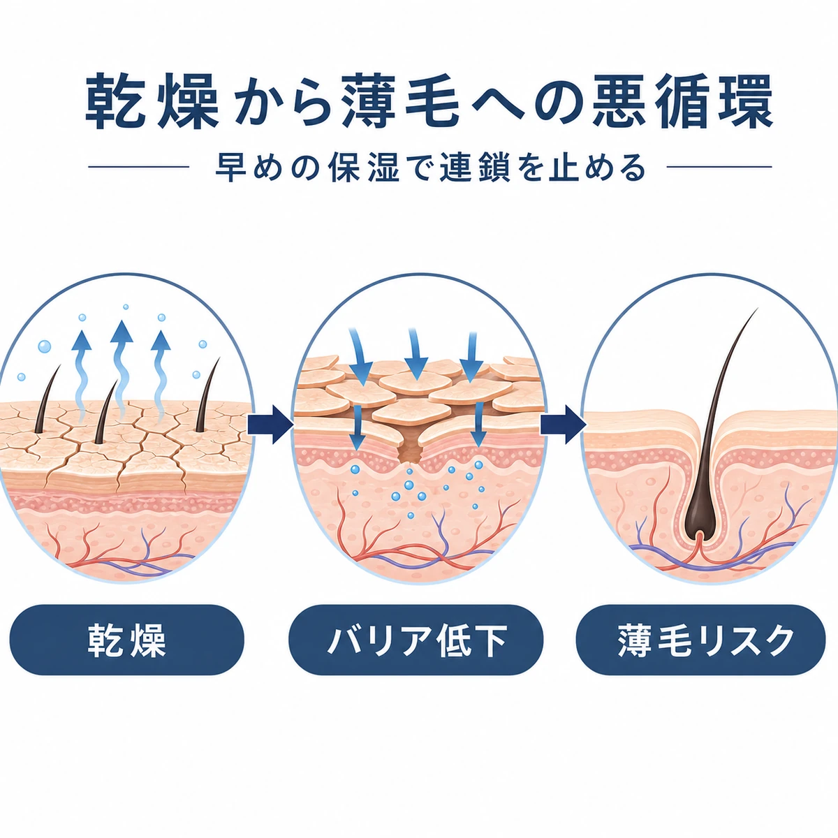 頭皮の乾燥がバリア低下を経て薄毛リスクへつながる流れを表した医療イラスト