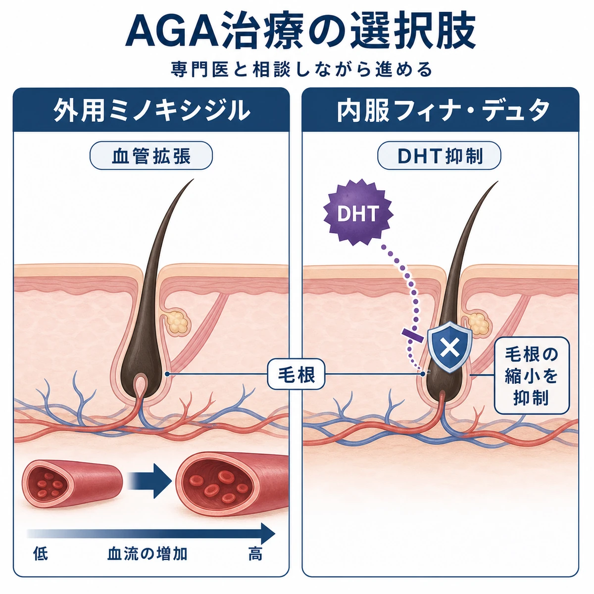 外用薬の血管拡張と内服薬のDHT抑制という二つのAGA治療の作用を対比した医療イラスト