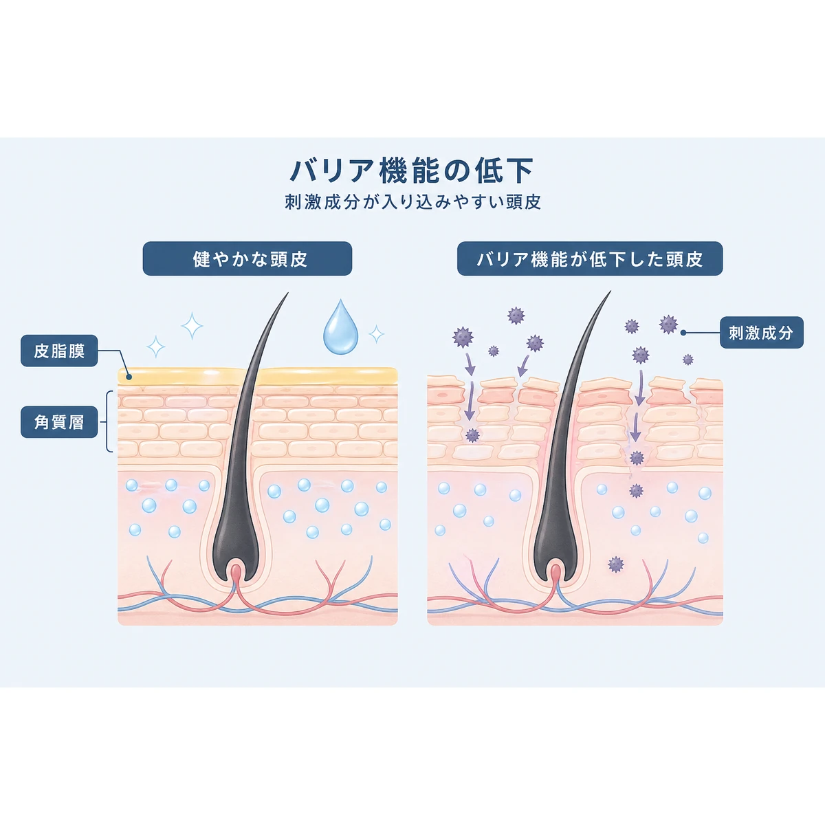 敏感肌の頭皮でバリア機能が低下し刺激成分が入り込みやすくなる仕組みを表した医療イラスト