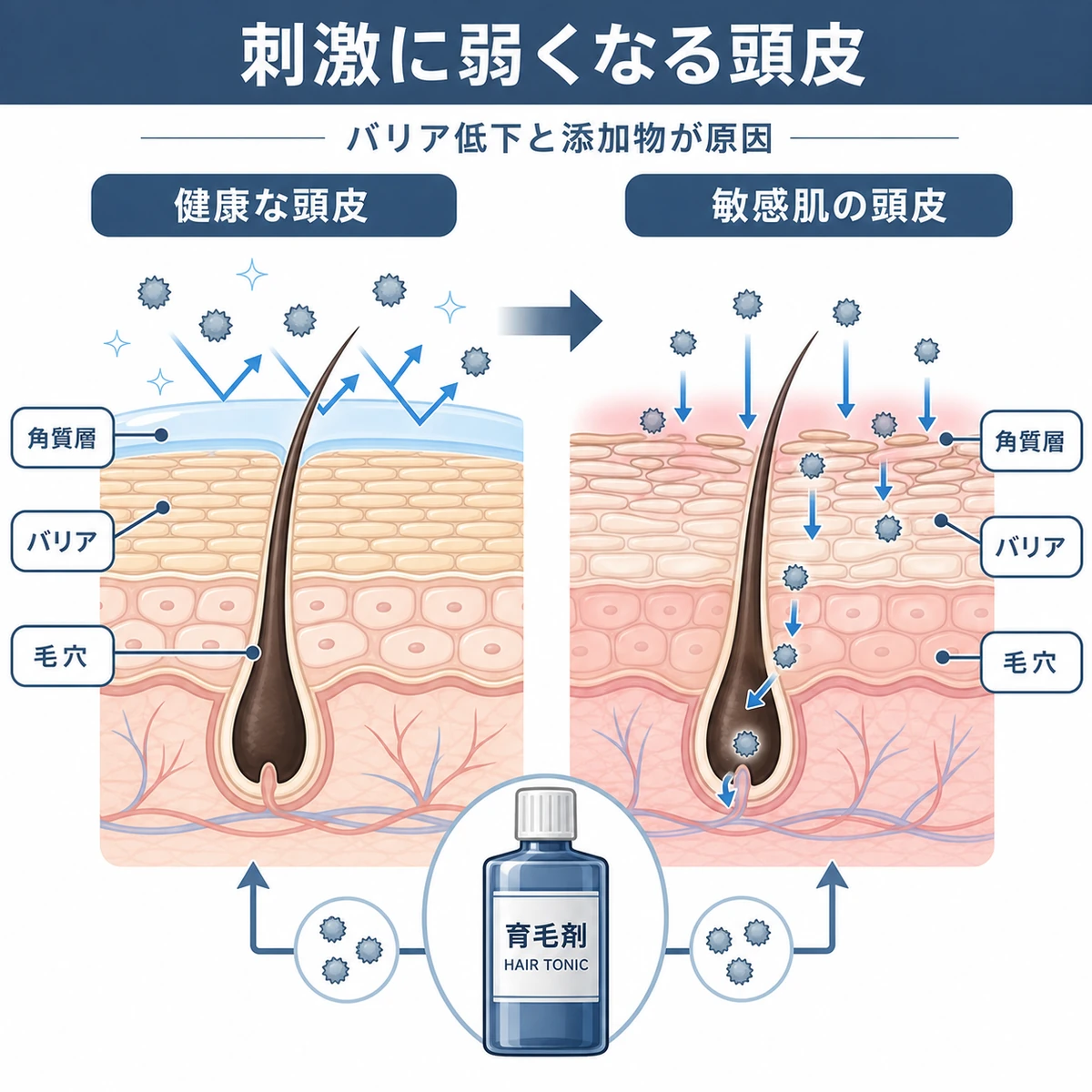 健康な頭皮と敏感肌の頭皮のバリアの違いを断面図で対比した医療イラスト