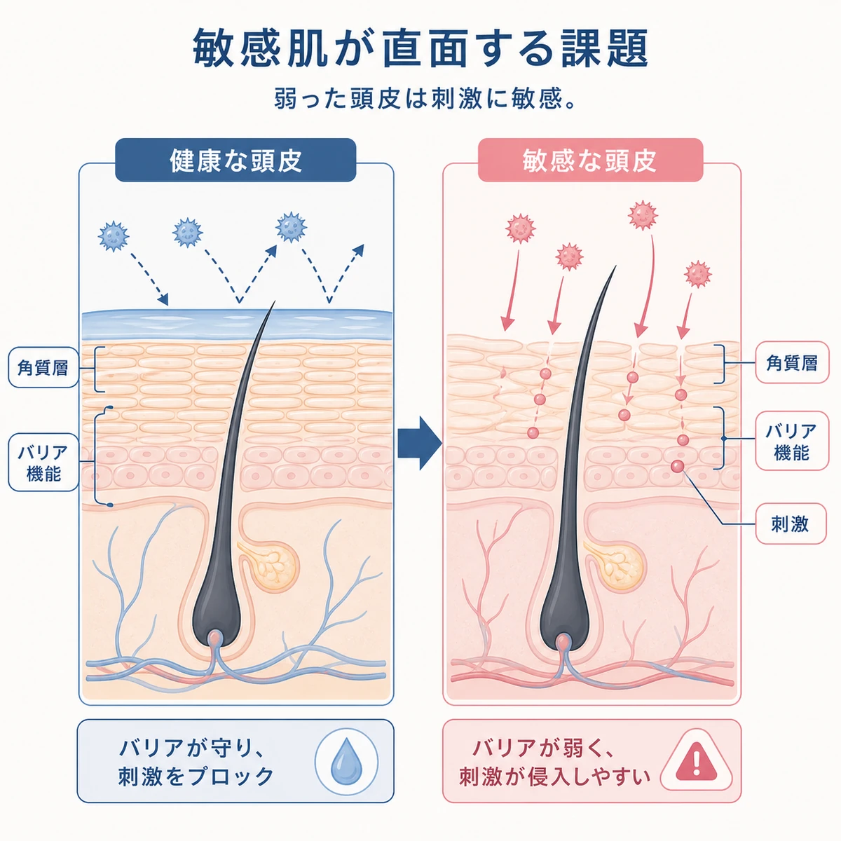 健康な頭皮と敏感な頭皮の角質層の違いを断面図で穏やかに対比した医療イラスト