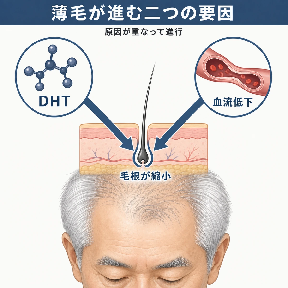 DHTと血流低下という二つの要因が毛根の縮小を招くしくみを表した医療イラスト
