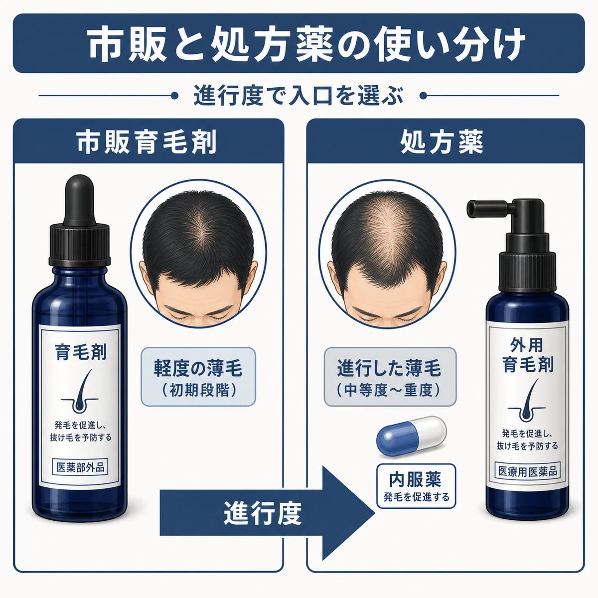 薄毛の進行度に応じて市販育毛剤と処方薬を使い分ける流れを表した医療イラスト