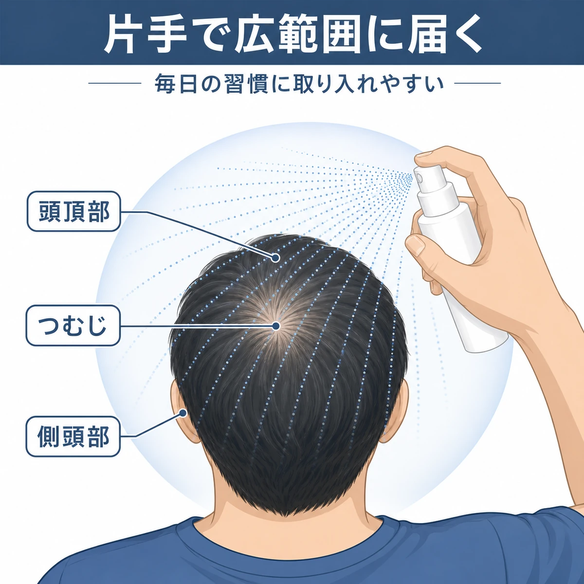 無地スプレー容器から頭頂部・つむじ・側頭部へ放射状に薬液が広がる様子を表した育毛イラスト