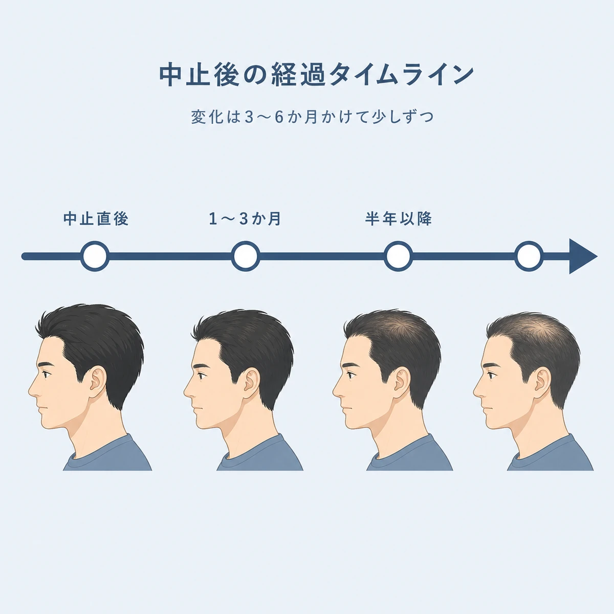 育毛剤の中止後に抜け毛が段階的に変化していく経過を左から右の時間軸で表した医療イラスト