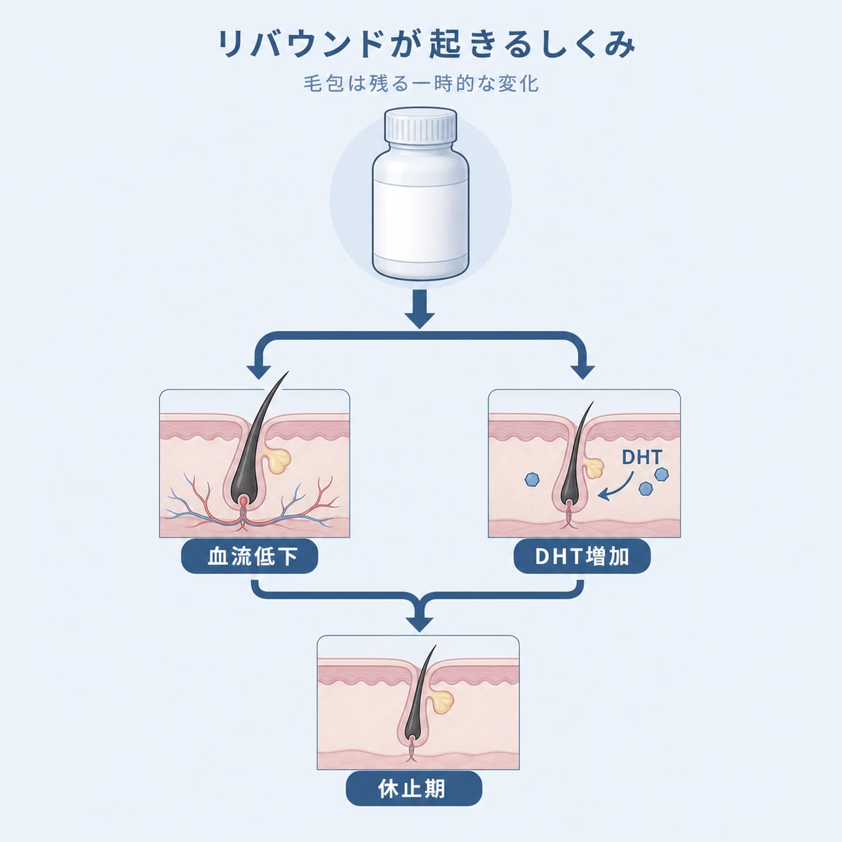 育毛剤の中止で血流低下とDHT増加が起こり毛根が休止期へ移行するリバウンドの仕組みを表した医療イラスト