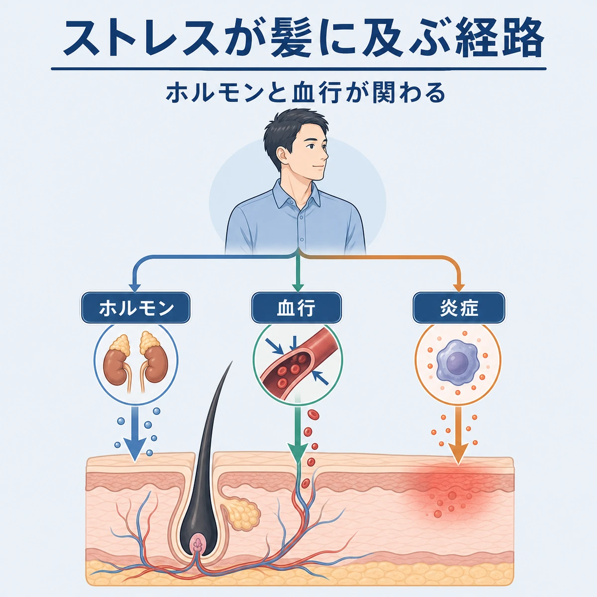 ストレスがホルモン・血行・炎症の3つの経路で毛根に届く仕組みを表した医療イラスト