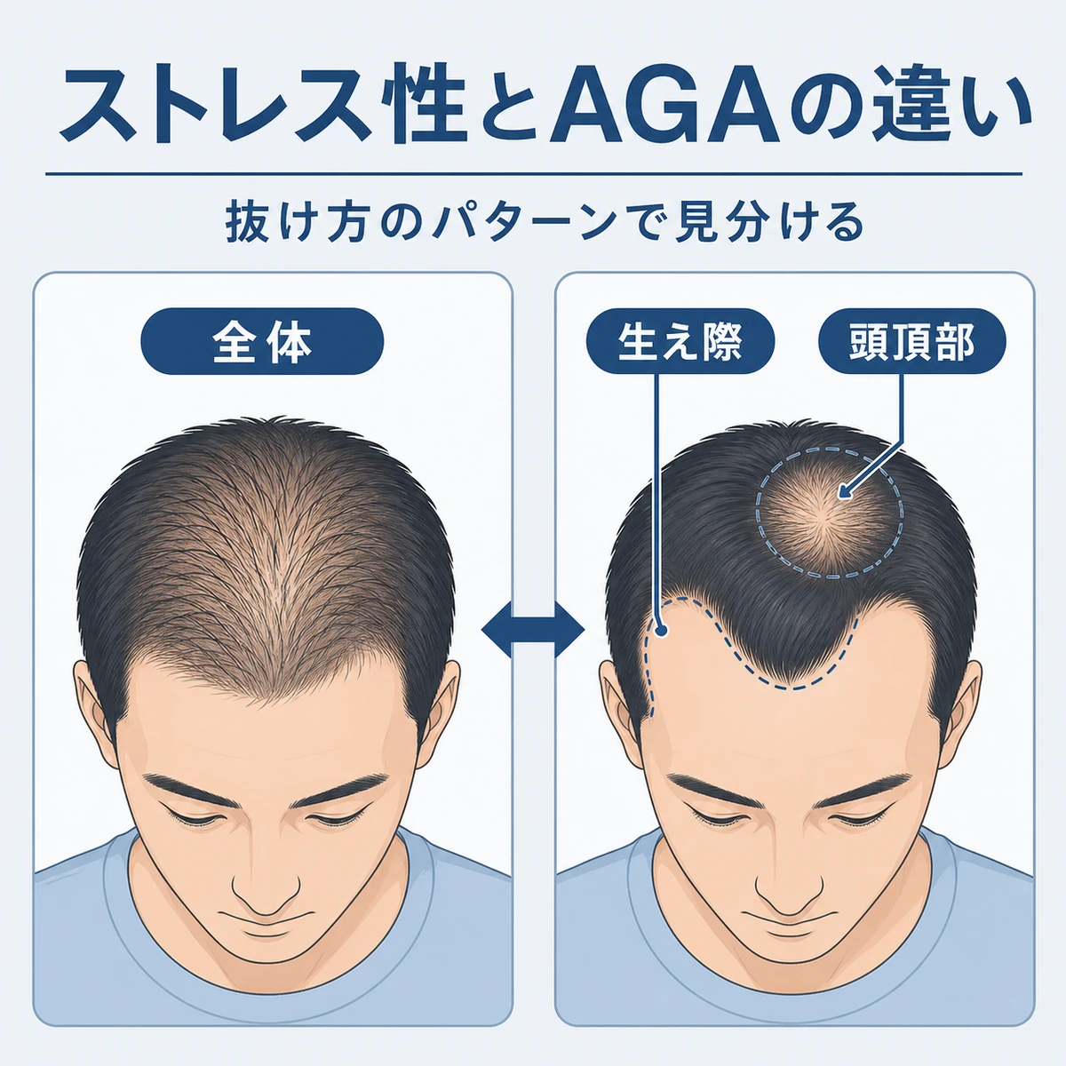 ストレス性脱毛とAGAの抜け方の違いを左右で対比した成人男性の医療イラスト