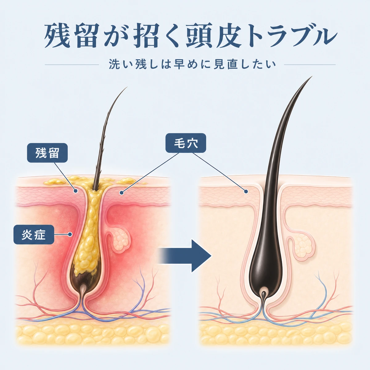 整髪料の残留で毛穴が詰まった頭皮と清潔な頭皮を断面で比べた育毛イラスト