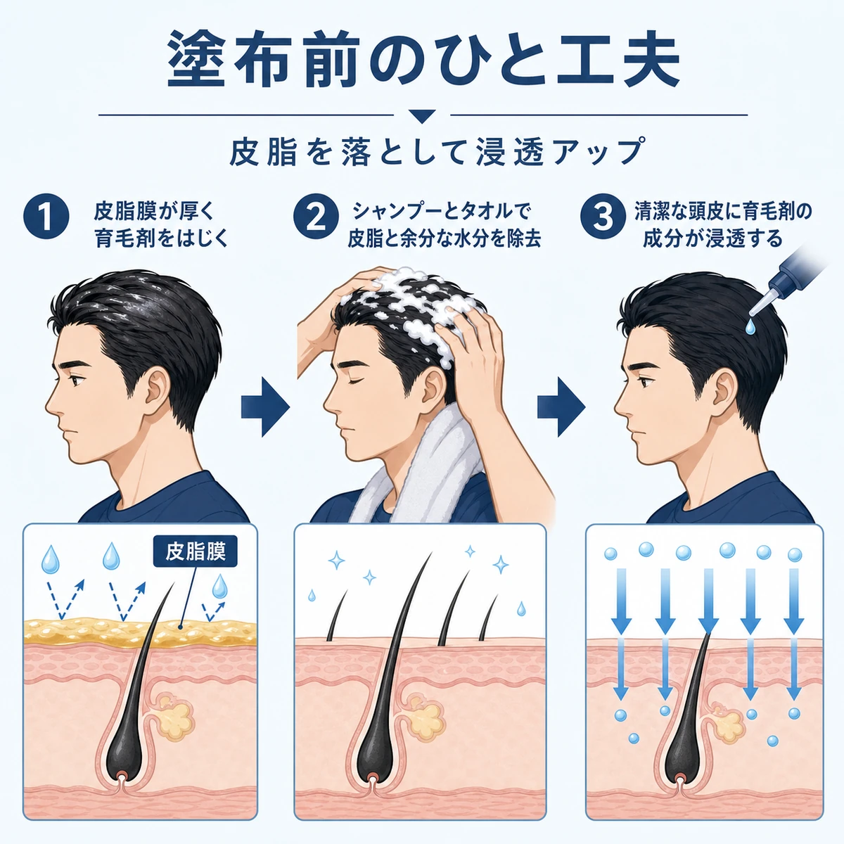 皮脂を落として夏でも育毛剤が頭皮に浸透しやすくなる塗布前の工夫を表した医療イラスト